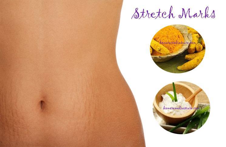http://www.homeremediescare.com/wp-content/uploads/2015/01/Stretch-Marks-Home-Remedy.jpg