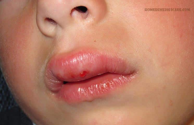 Swollen Upper Lip - Buzzle