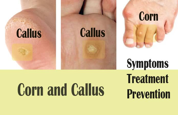 blisters , calluses and corns - kids health