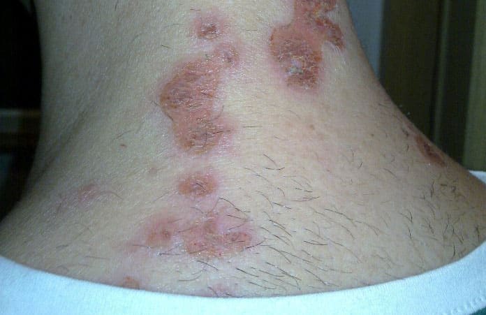 Natural Remedies For Bacterial Infection On Skin Natural Remedies For Bacterial Infection On Skin