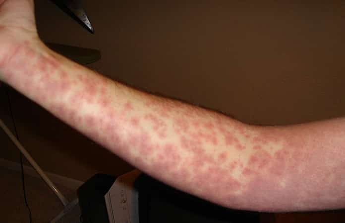 What is heat rash?