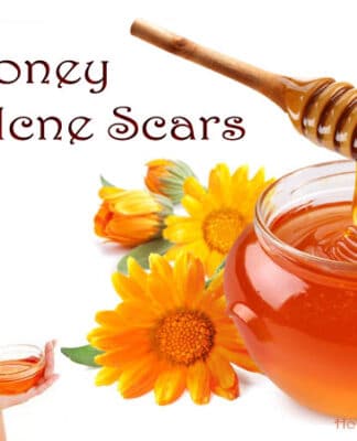 8 easy home remedies for acne
