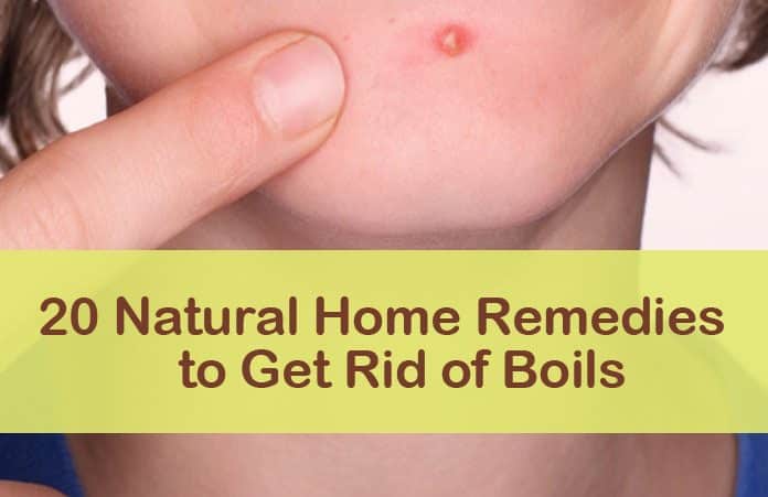 Home Remedies to Get Rid of Boils
