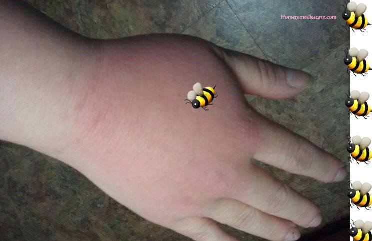 best home remedy for hornet sting