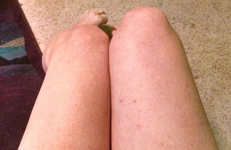 15 Home Remedies To Get Rid Of Razor Bumps Or Bikini Bumps Fast