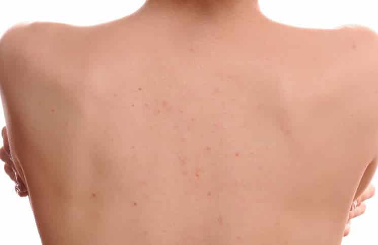 Home Remedies to Get Rid of Back Acne
