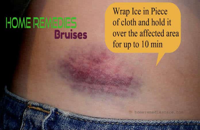 treat bruises home remedy