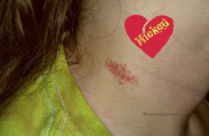 Home Remedies to Get Rid of a Hickey Mark