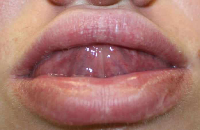 15 Natural Home Remdies to Get Rid of Fordyce Spots