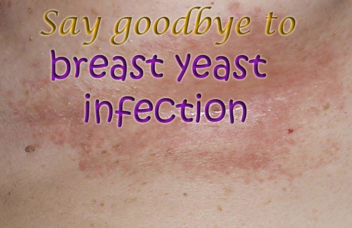 15 Natural Home Remedies to Get Rid of Yeast Infection Under Breast