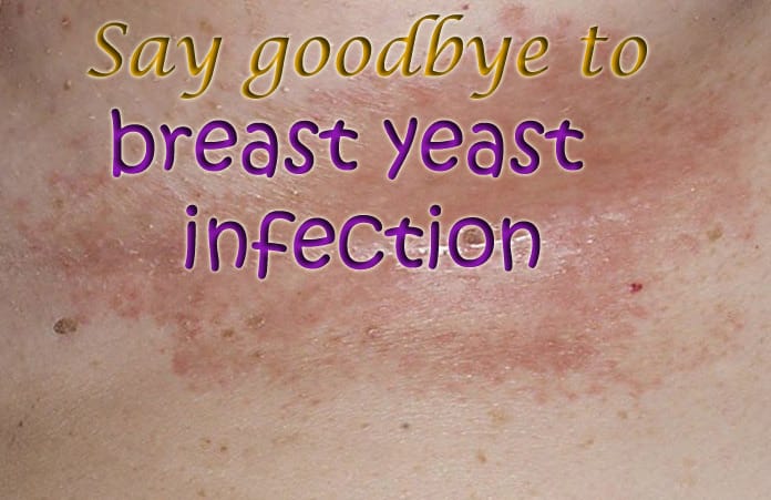 15 Natural Home Remedies To Get Rid Of Yeast Infection Under Breast