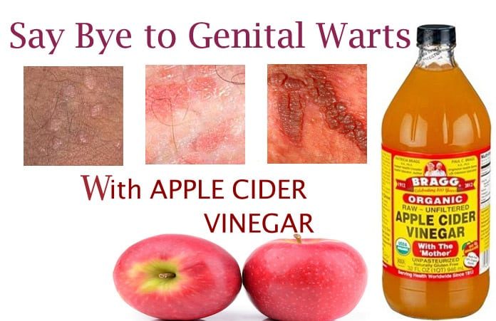 How to Get Rid of Genital Warts Fast with Apple Cider Vinegar