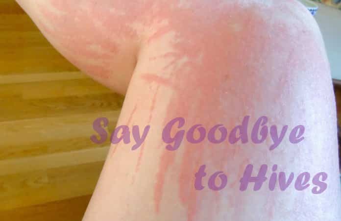 Home Remedies to Get Rid of Hives Fast