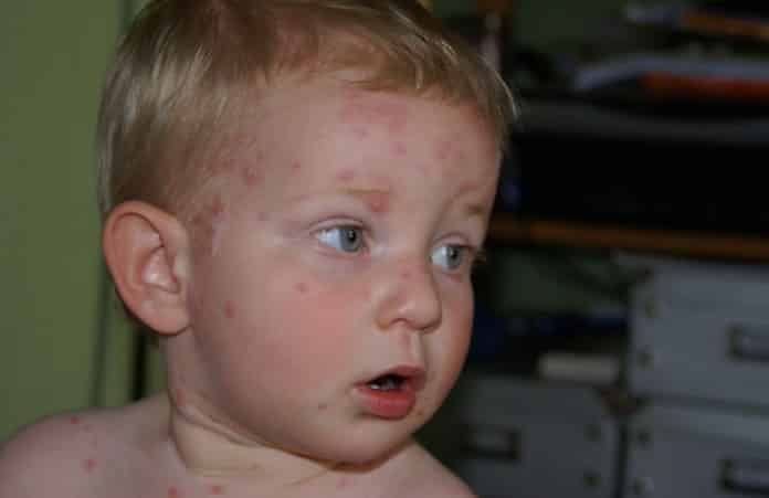 Easy Home Remedies for Curing Chicken Pox
