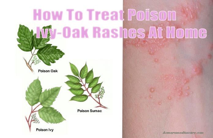 home remedies to cure poison-ivy-oak-surmac rashes