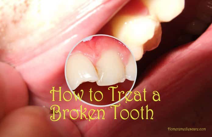Home Remedies for Broken Tooth - Relieve The Pain Soon