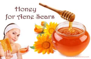 Honey for Acne Scars