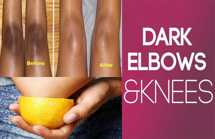 Home Remedies to Get Rid of Dark Elbows and Knees Fast