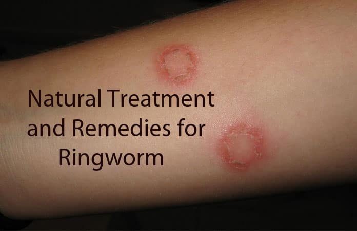 15 Effective And Useful Home Remedies To Get Rid Of Ringworm