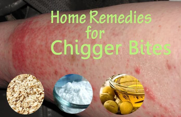 Home Remedies to Get Rid of Chigger Bites