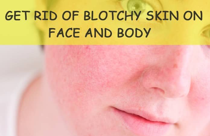 Home Remedies To Get Rid Of Blotchy Skin