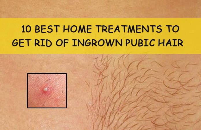 How to Get Rid Of Ingrown Pubic Hair